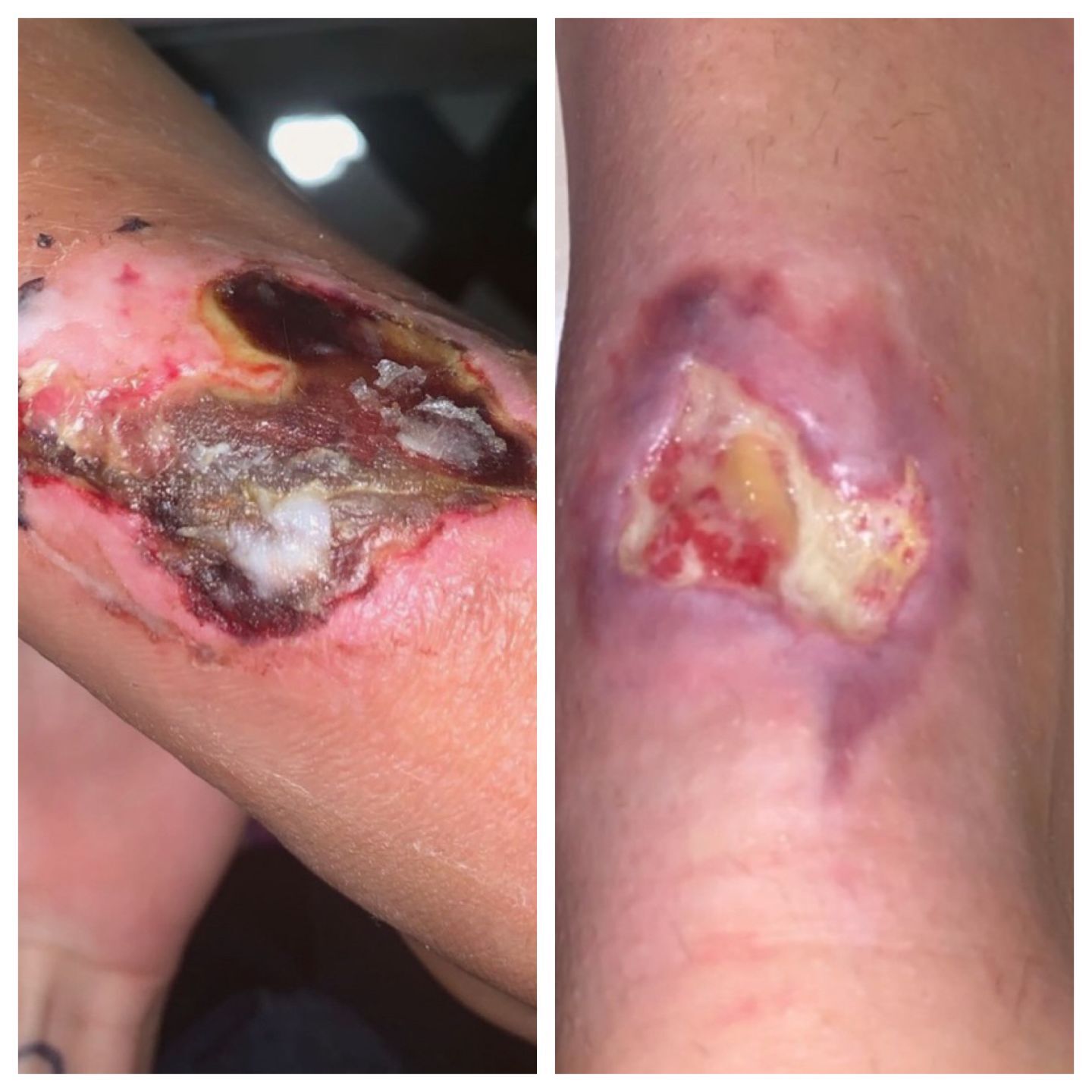 Foot burn: Note, these images may be disturbing to some